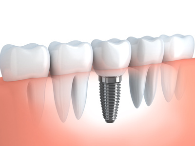 dental implant hamilton