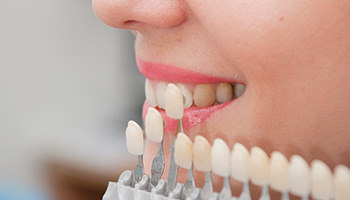 dental veneers in hamilton and ancaster